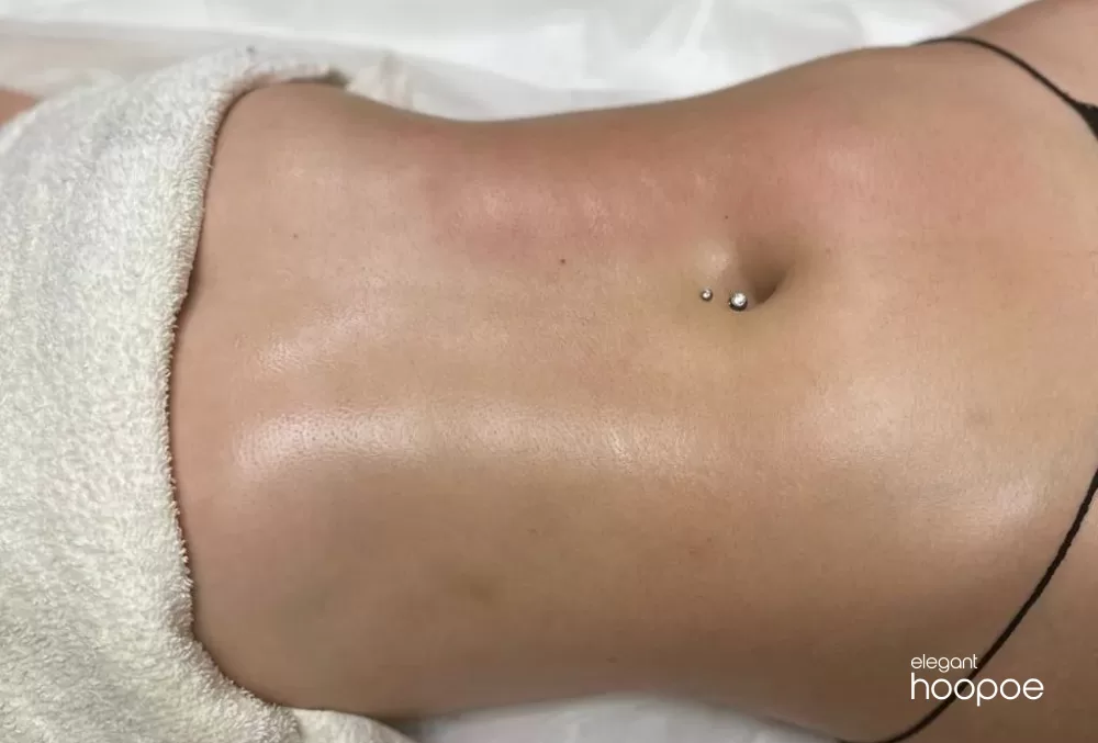 Laser Liposuction in Dubai Results